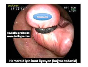 hemeroid2